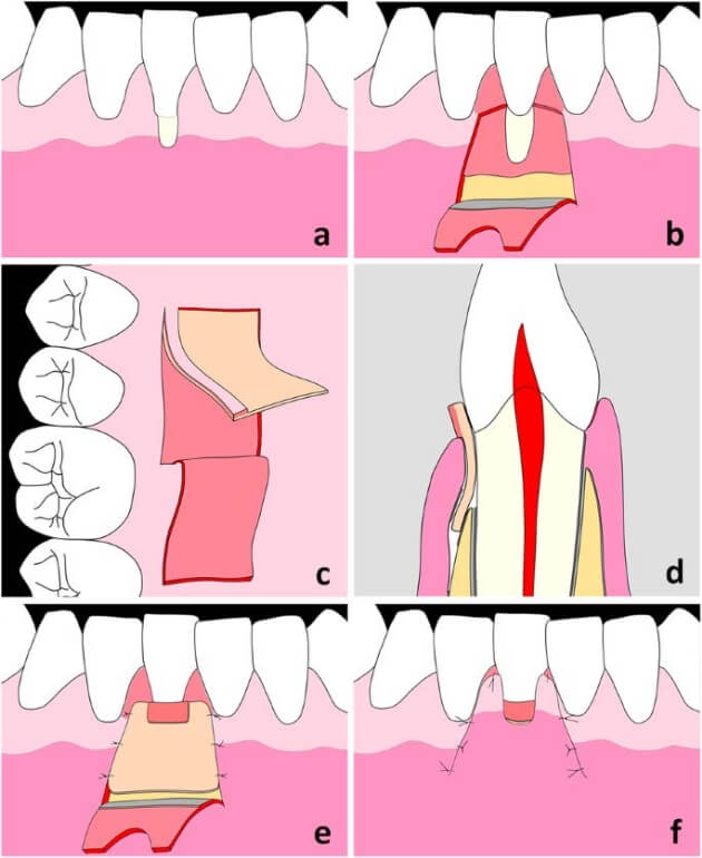 歯肉退縮の治療法