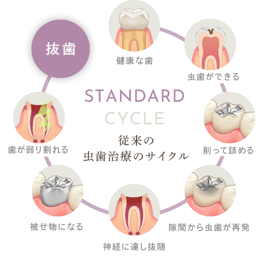 従来の虫歯治療のサイクル
