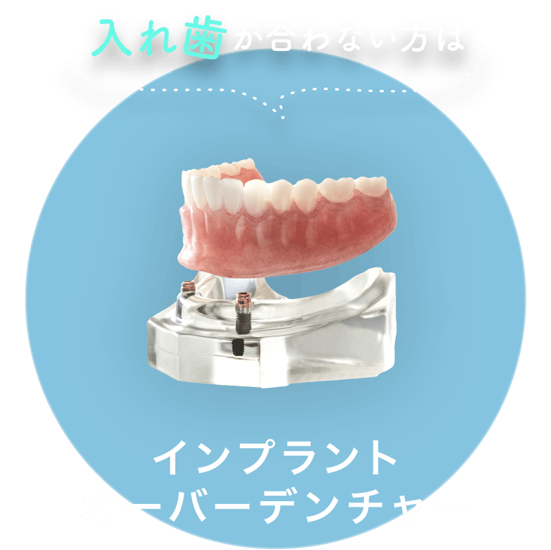 入れ歯が合わない方は：インプラントオーバーデンチャー