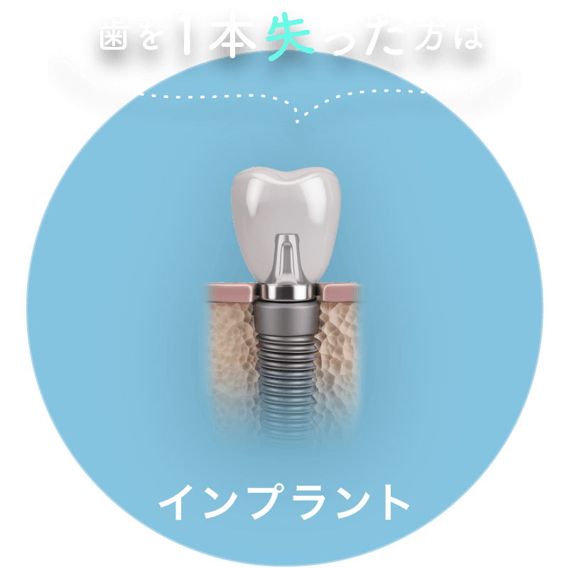 歯を1本失った方は：インプラント