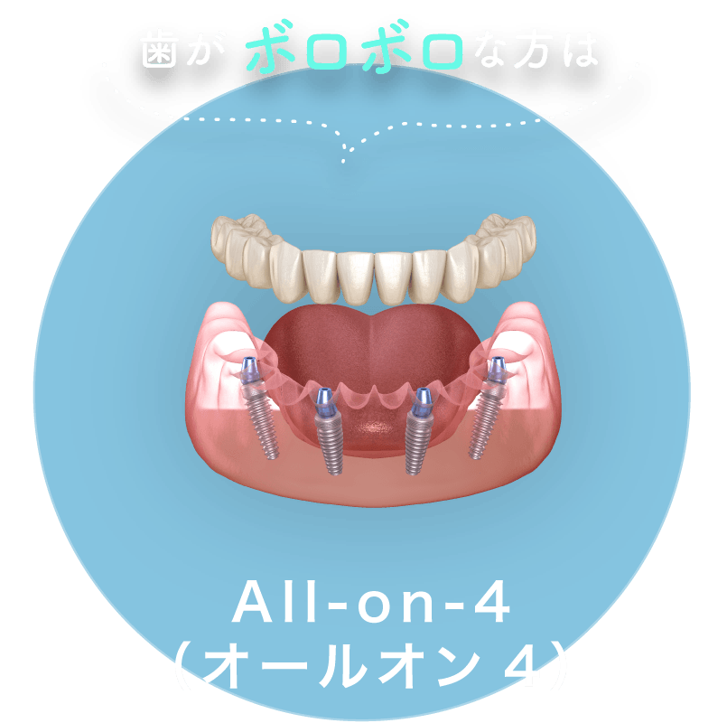 歯がボロボロな方は：All-on-4（オールオン4）