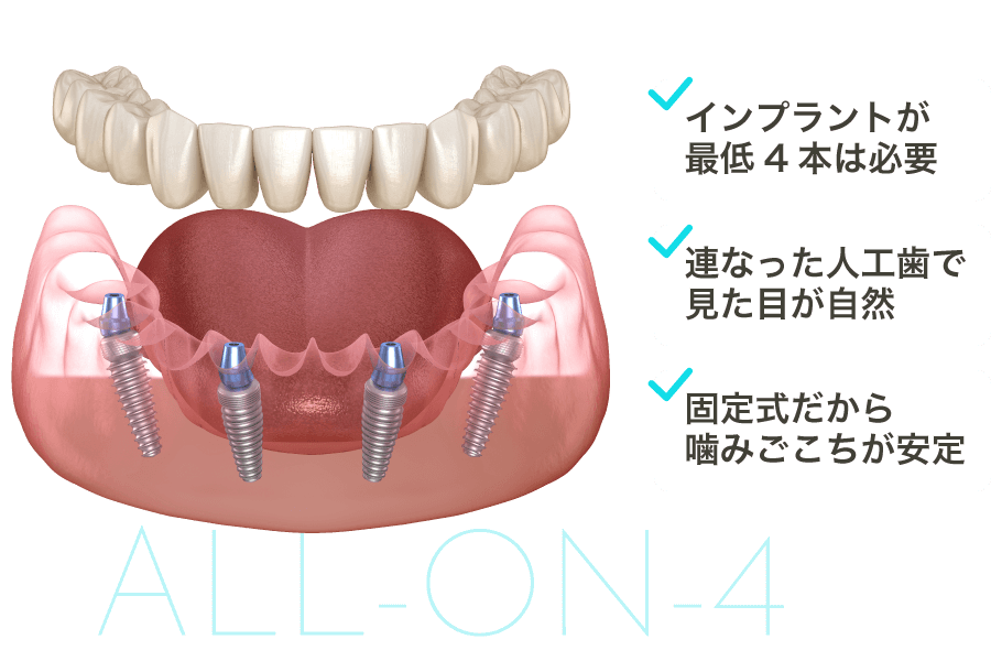 インプラントが最低4本は必要/連なった人工歯で見た目が自然/固定式だから噛みごこちが安定