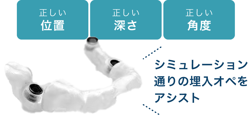 シミュレーション通りの埋入オペをアシスト