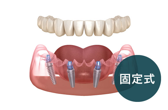 All-on-4（オールオンフォー）