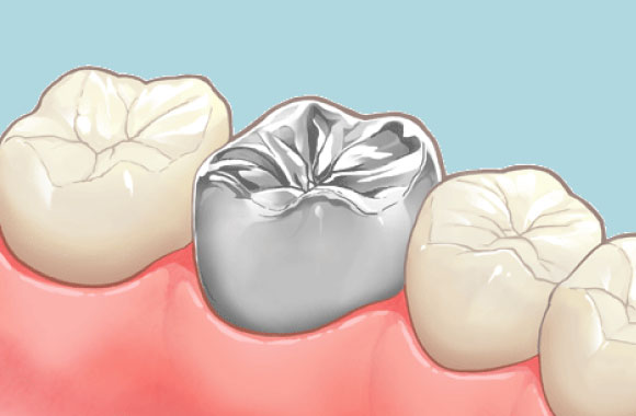フルメタルクラウン
