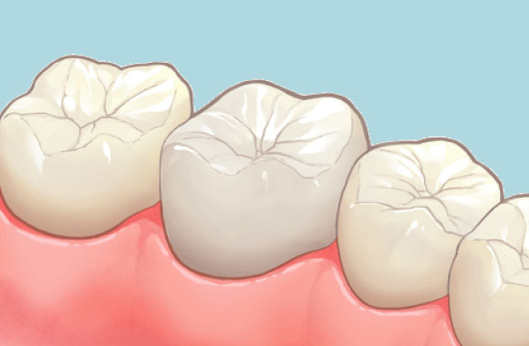 ジルコニアクラウン