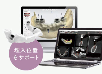 埋入位置をサポート