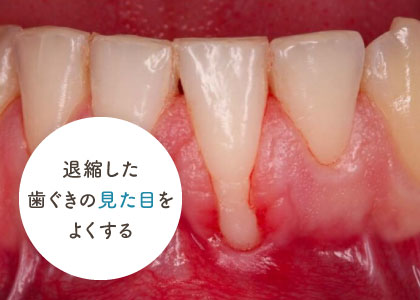 退縮した歯ぐきの見た目をよくする